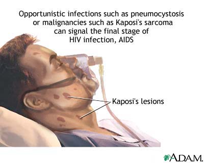 "Infecções oportunistas como a pneumocistose ou malignas, como a de Kaposi podem sinalizar o estágio final das infecções por HIV, AIDS".